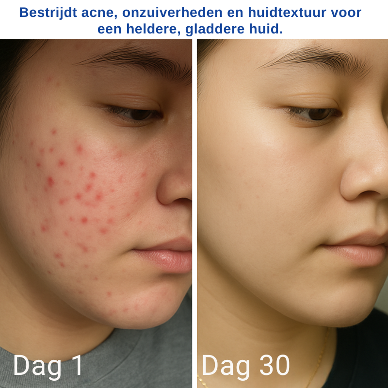 Excellent A313 Huidverjonging