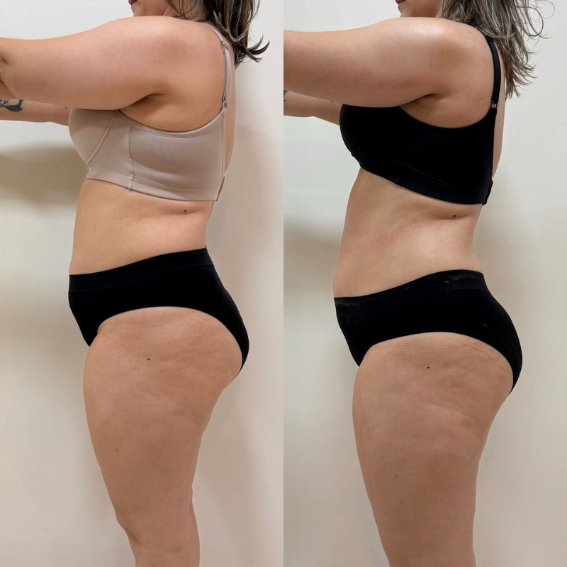 Flowziax Anti Cellulite Massage Olie