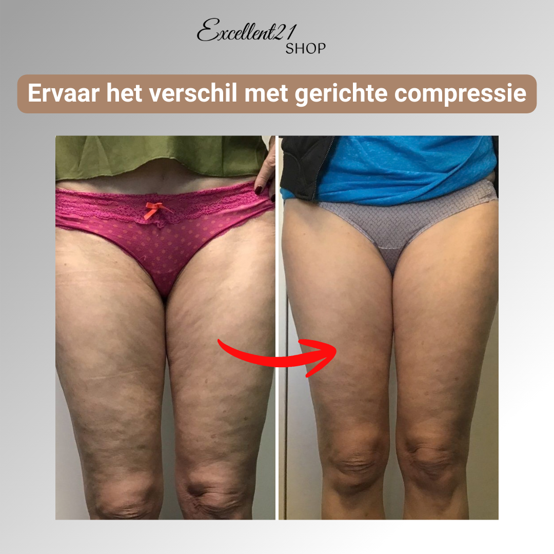 NOVA | 3D Compressie Legging voor Lipoedeem Comfort